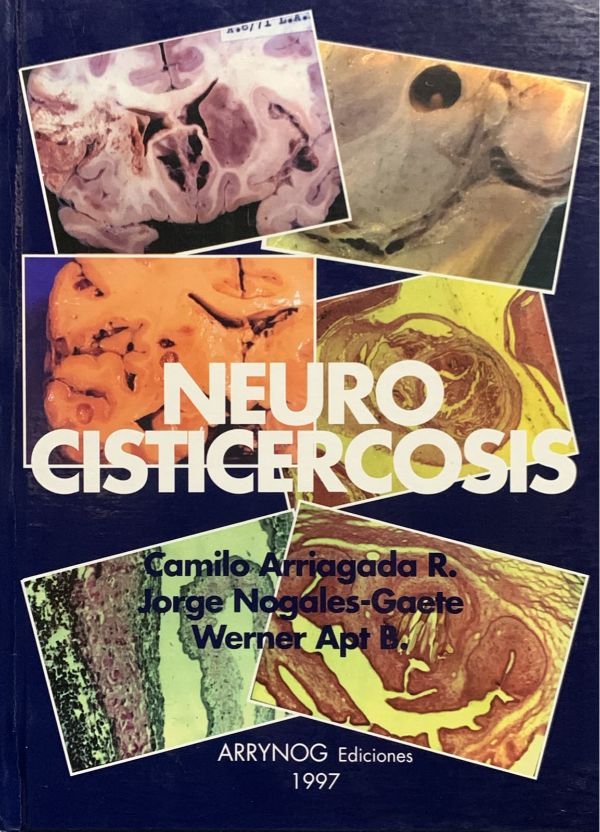 Neurocisticercosis / Tapa Dura